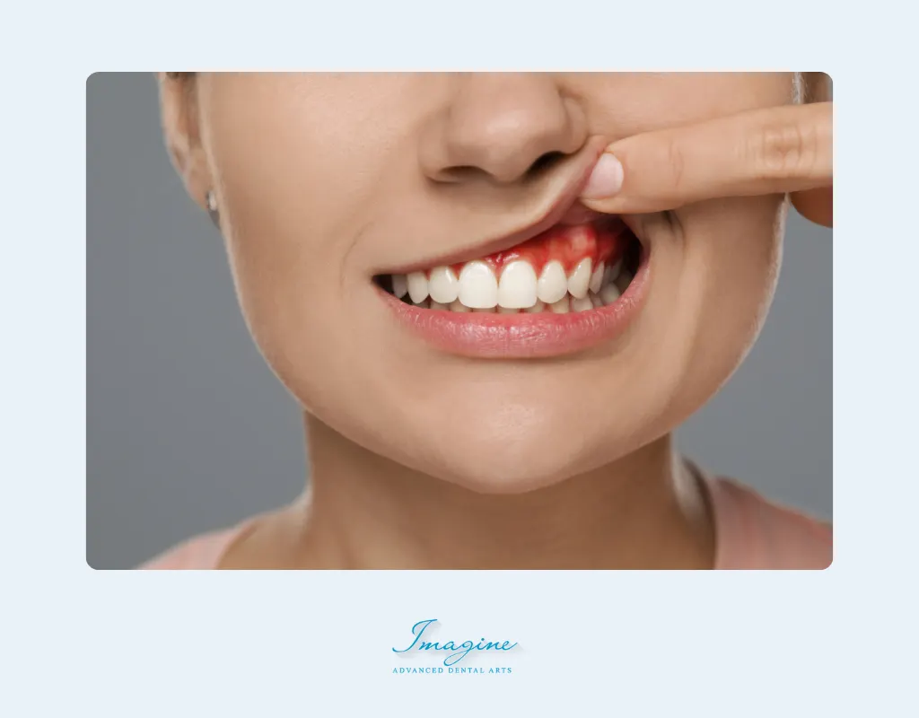 What Is Gingivitis?