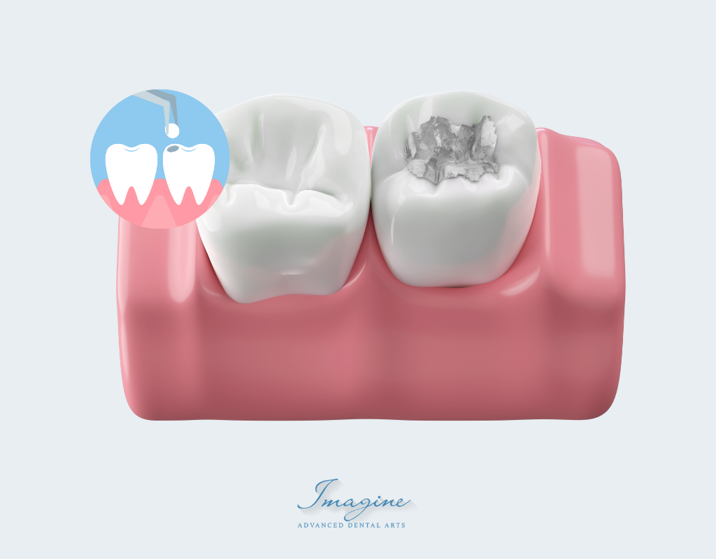 How Dental Fillings Work