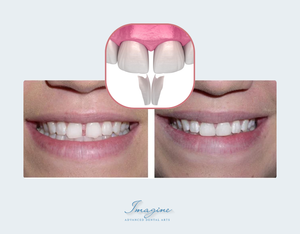 How Dental Bonding Works