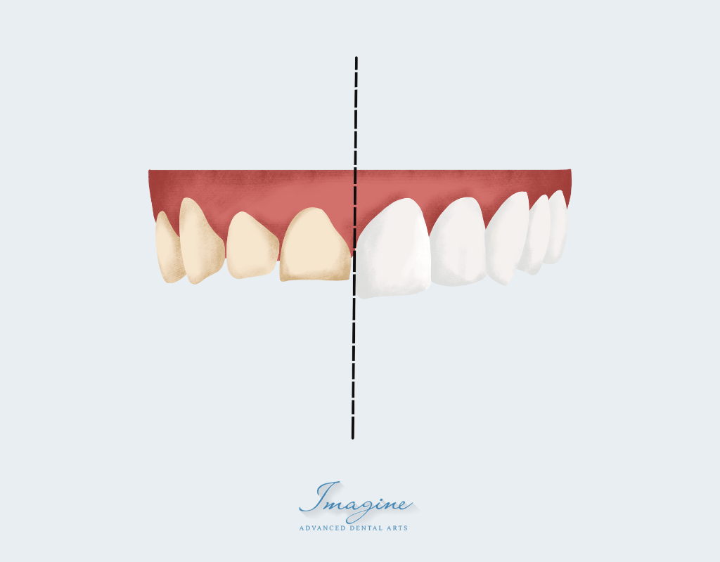Porcelain veneers for a natural-looking smile