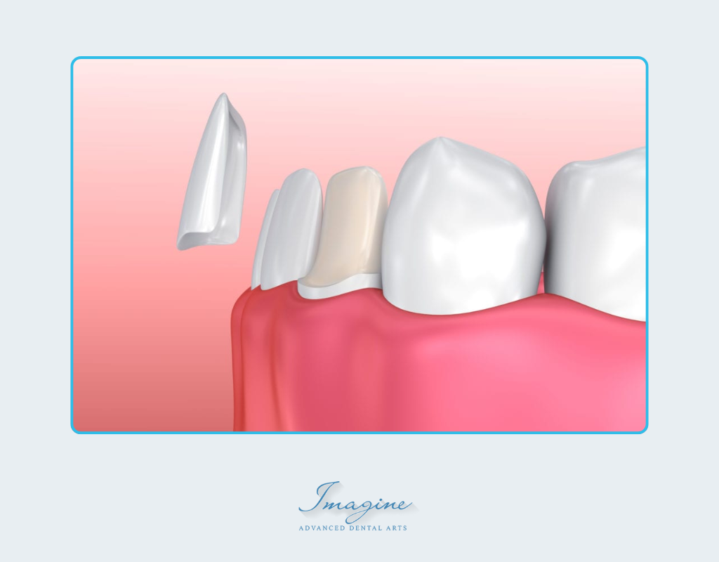 Porcelain veneers concealing chips, stains, and gaps
