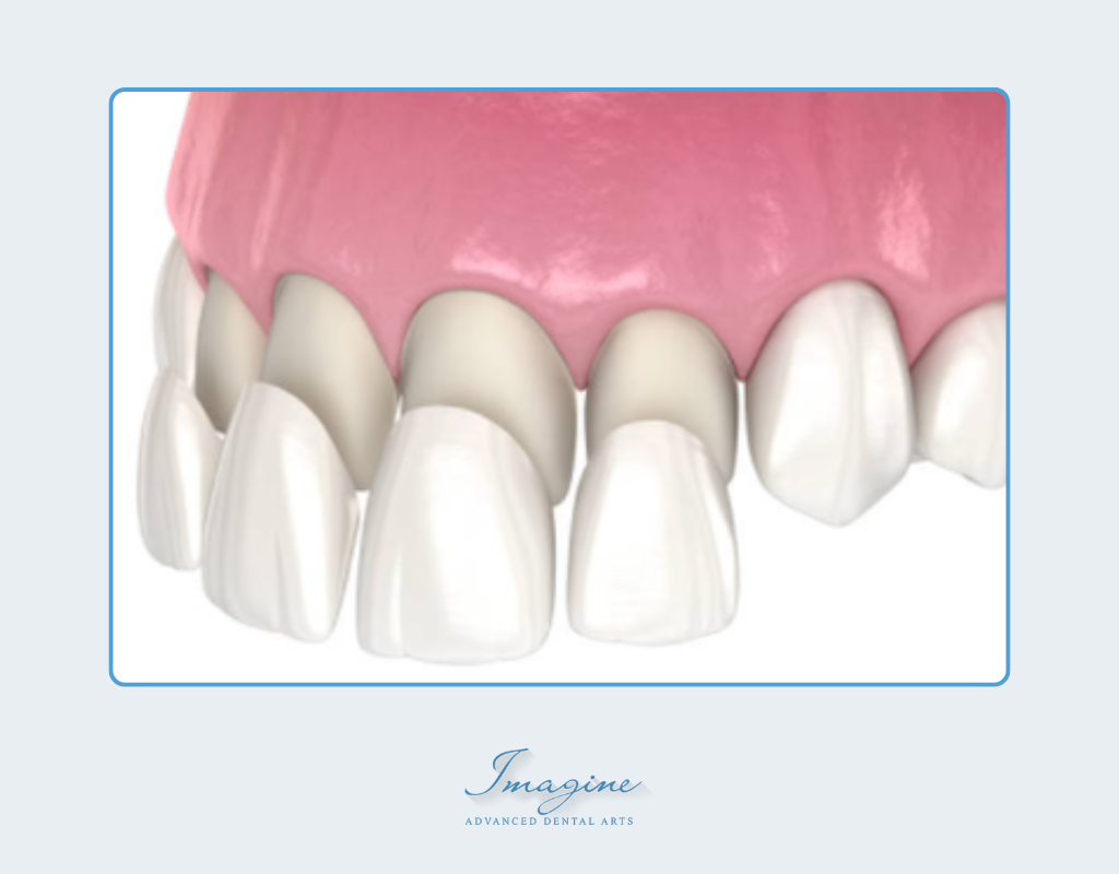 The porcelain veneers treatment process