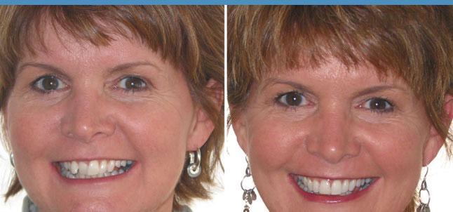 Six Month Smiles clear braces treatment