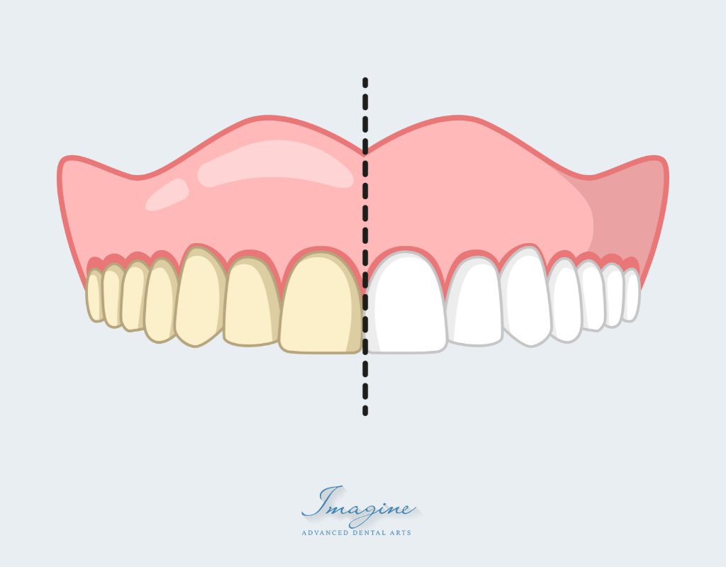 Bright, white smile after professional teeth whitening