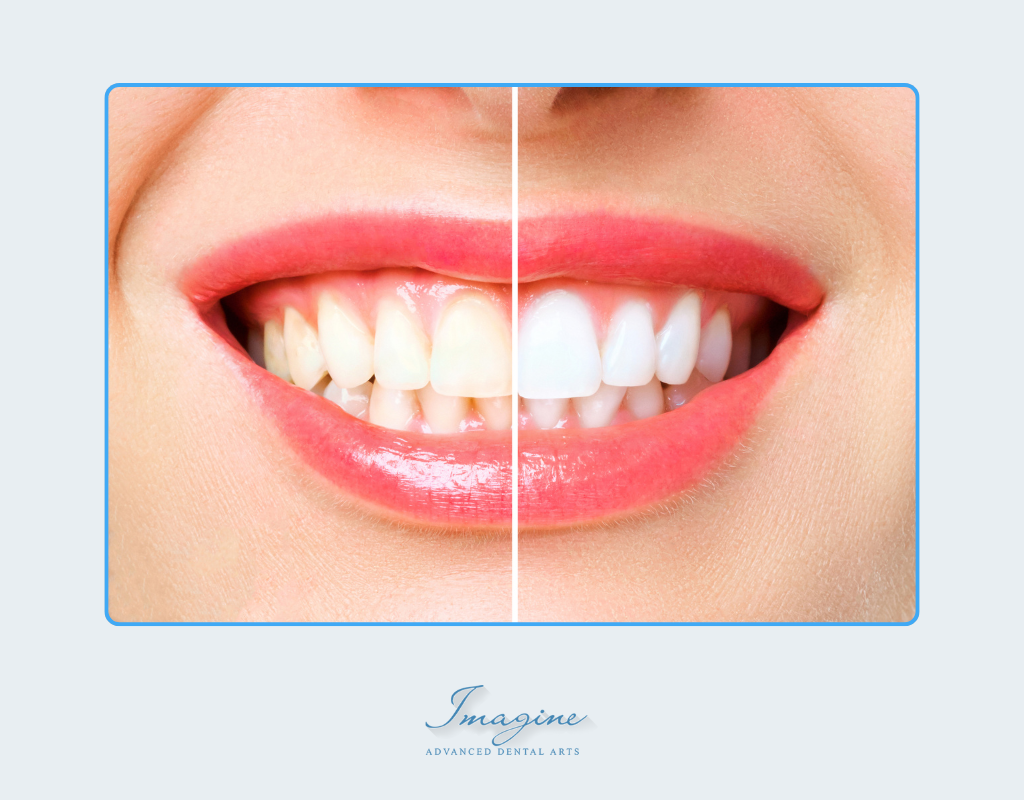 Teeth whitening treatment at the dental office