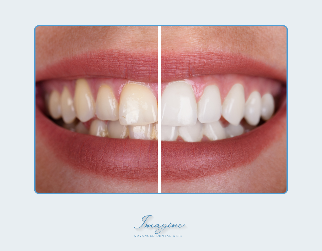 How tooth whitening works with peroxide gel