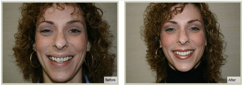 Smile Makeover Plan